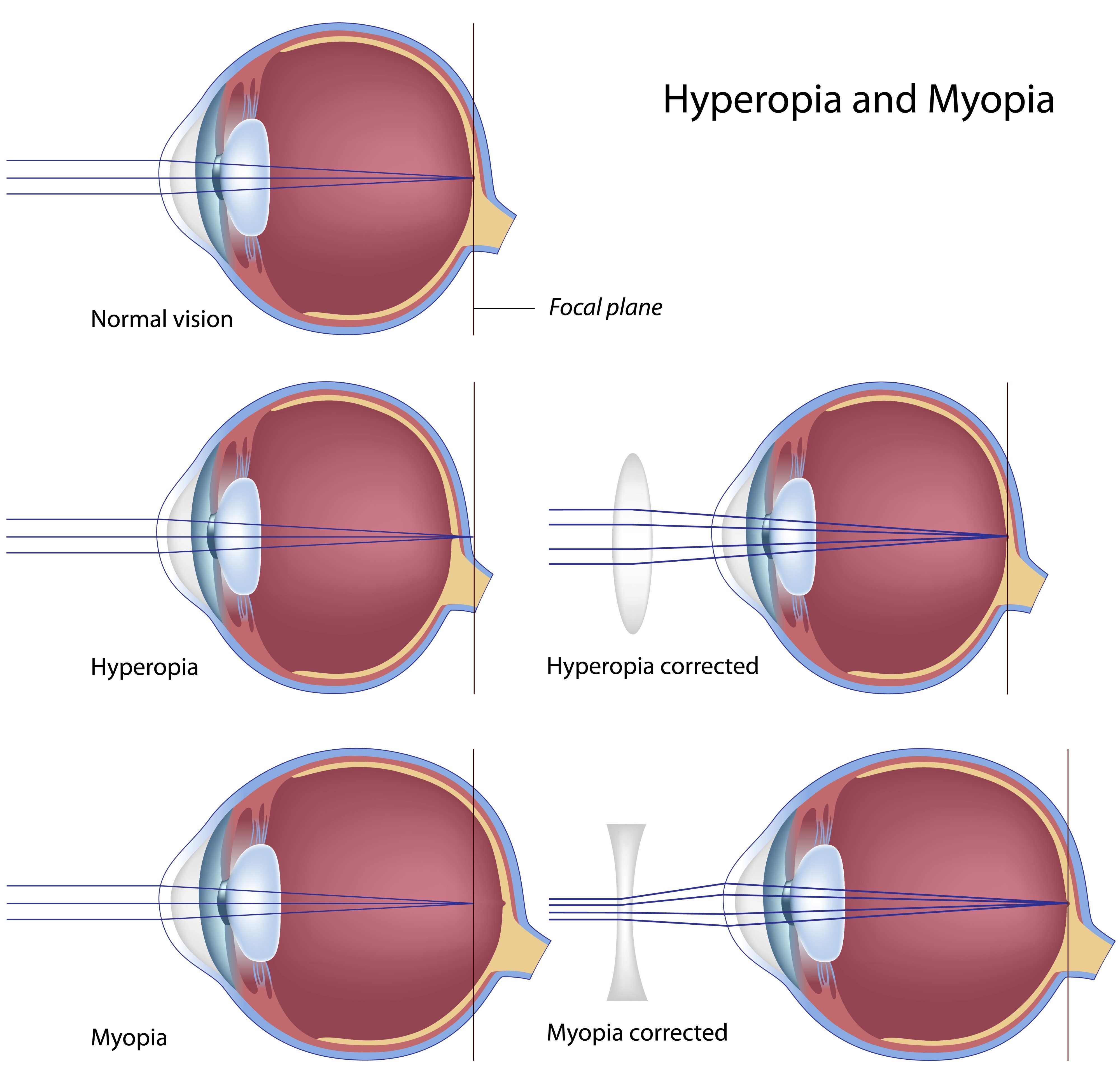 Spectacles: A Tale of Serendipity, Science and Design II – Dr. Jorge